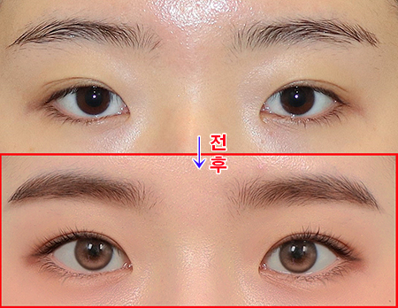  매몰눈매교정 + 코성형으로 또렷해진 이목구비,<눈코성형후기 치유>