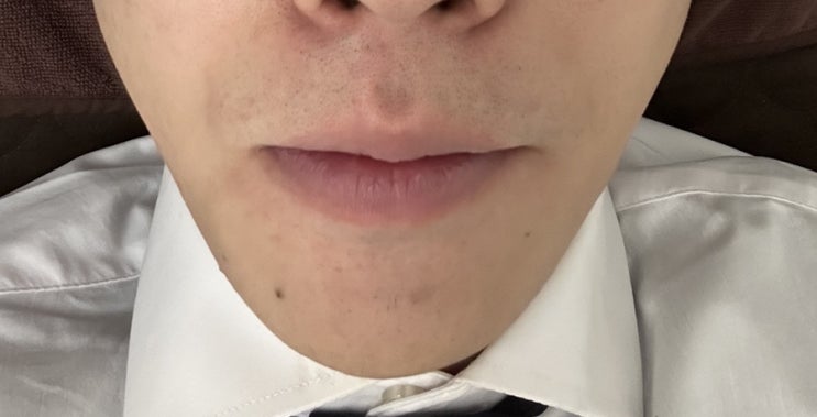  수염 제모 5회차 2달 쉬고 다시 하니 쉬는 기간에 너무 자라 너는 혹시 콩나물이니?