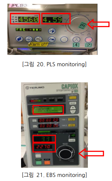 ECMO 간호 2 :: ECMO삽입 후 간호 : 네이버 블로그