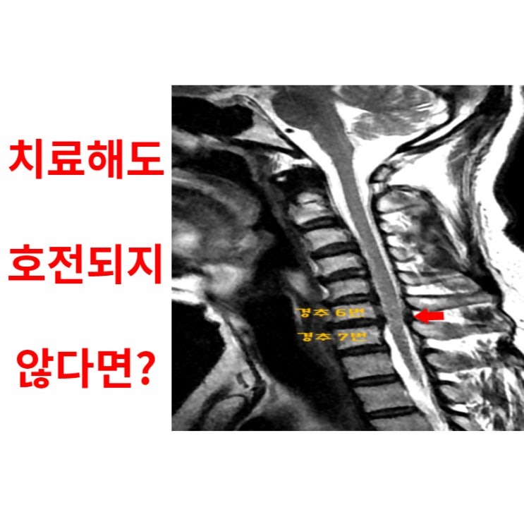  광주목통증병원, 치료해도 호전되지 않은 이유