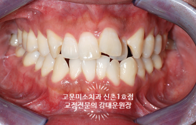  튀어나온 앞니 앞니돌출 반대교합 2급부정교합치료 신촌 교정전문의 강대운원장 고운미소 신촌1호점 치료증례