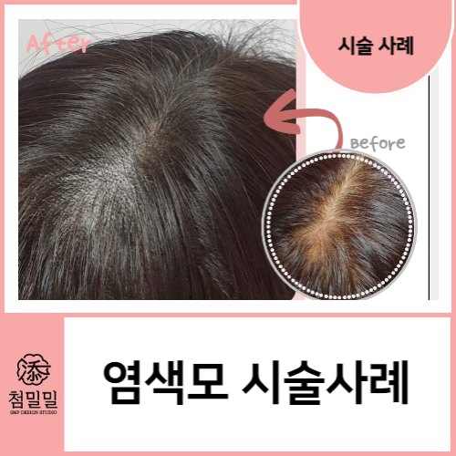  포항 여성탈모 SMP 두피커버, 염색모발과 흰머리에도 가능할까요?