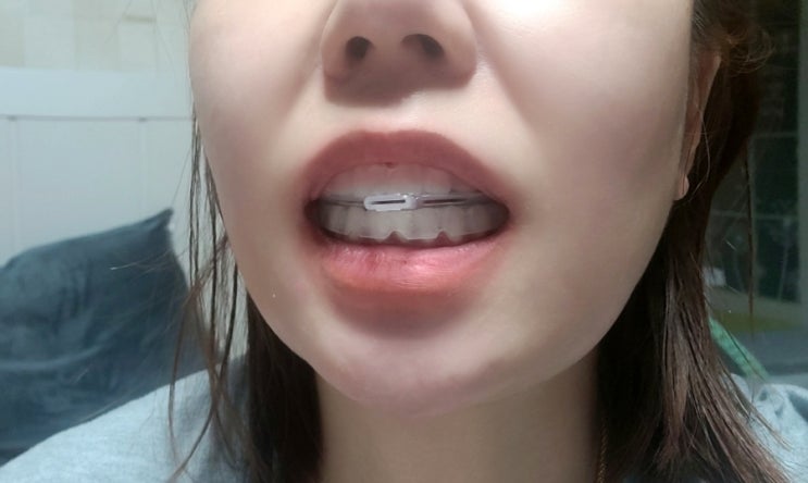  안면비대칭치료기 턱관절밸런스 맞추기 위한 밸런스테크