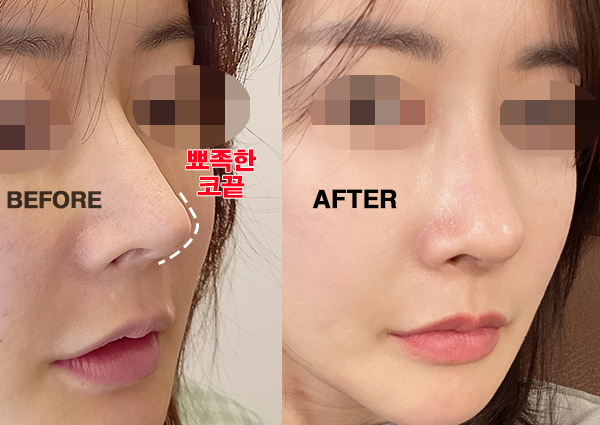 코재수술, 늑연골코성형 후 코끝 개선!(치유성형외과)