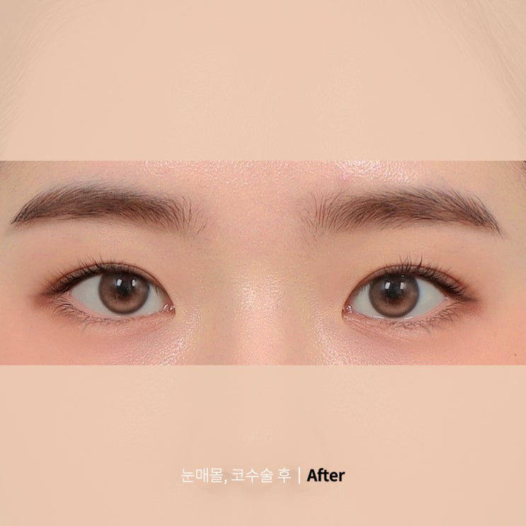  자연스러운 눈,코성형(치유성형외과 후기)