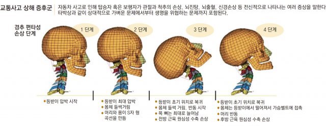 교통사고 났다면 경증이라도 초기에 꼼꼼하게 치료 받아야