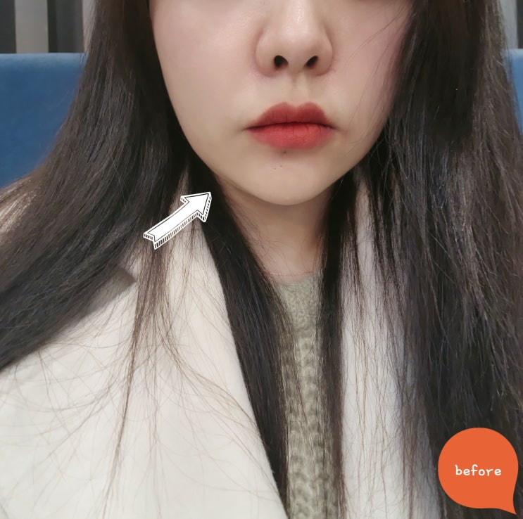  천안피부과추천 1주차 인모드후기