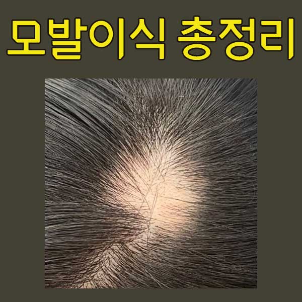  모발이식 3000모 5000모 현실적인 비용 알려드릴게요!
