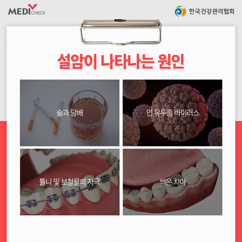 설암 초기증상과 원인, 입에 궤양이 낫지 않는다면 의심하세요 : 네이버 블로그