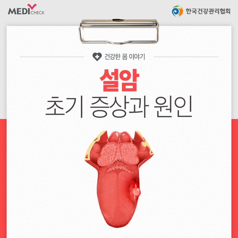 설암 초기증상과 원인, 입에 궤양이 낫지 않는다면 의심하세요 : 네이버 블로그
