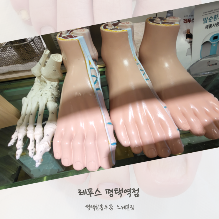  평택발톱무좀 스케일링 레푸스 평택역점