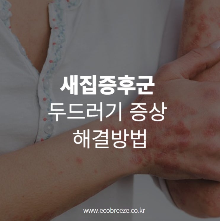 새집증후군 두드러기 증상 해결 방법 5가지