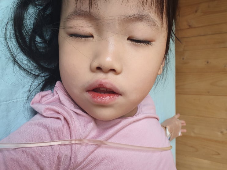  아기 아데노바이러스 고열 마른기침 증상 및 RSV 전염