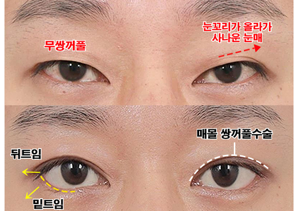  남자눈성형, 쌍꺼풀수술 후 부드러워진 인상!(신사역성형외과 치유)