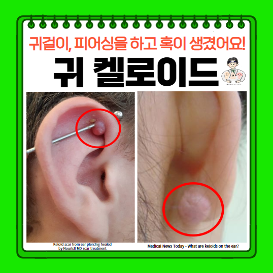  귀 켈로이드, 피어싱 켈로이드 살튀 원인 증상 치료 주사 수술