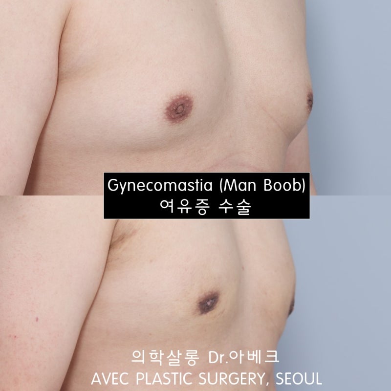 남자여유증병원, 16년 전문의가 알려드립니다.