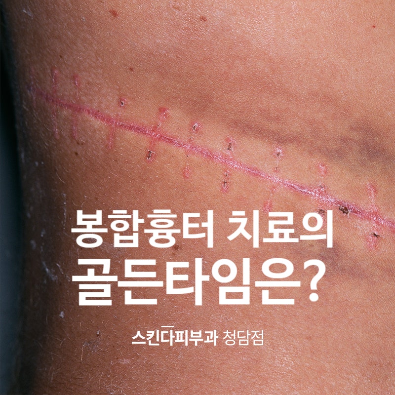 수술 꼬맨흉터 봉합흉터의 치료시기(켈로이드 주의)_청담피부과 : 네이버 블로그 수술 꼬맨흉터 봉합흉터의 치료시기(켈로이드 주의)_청담피부과 : 네이버 블로그