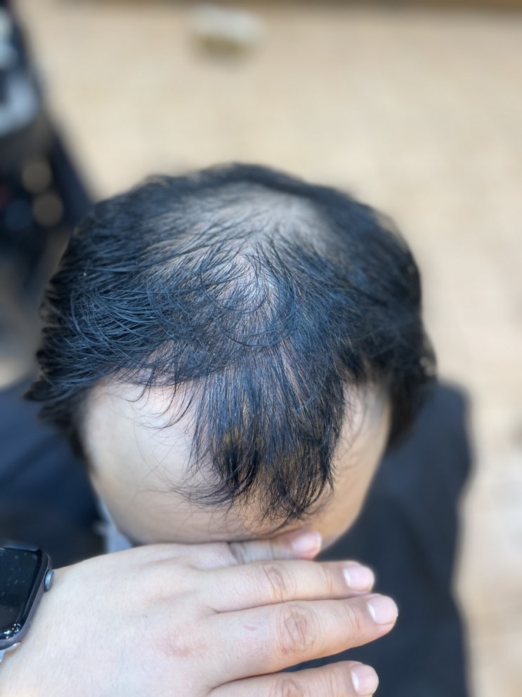  넓은이마 정수리탈모 파마로 탈모를 커버한다? 탈짱샘의 마법쇼가 곧시작합니다 없어도 너무없어!
