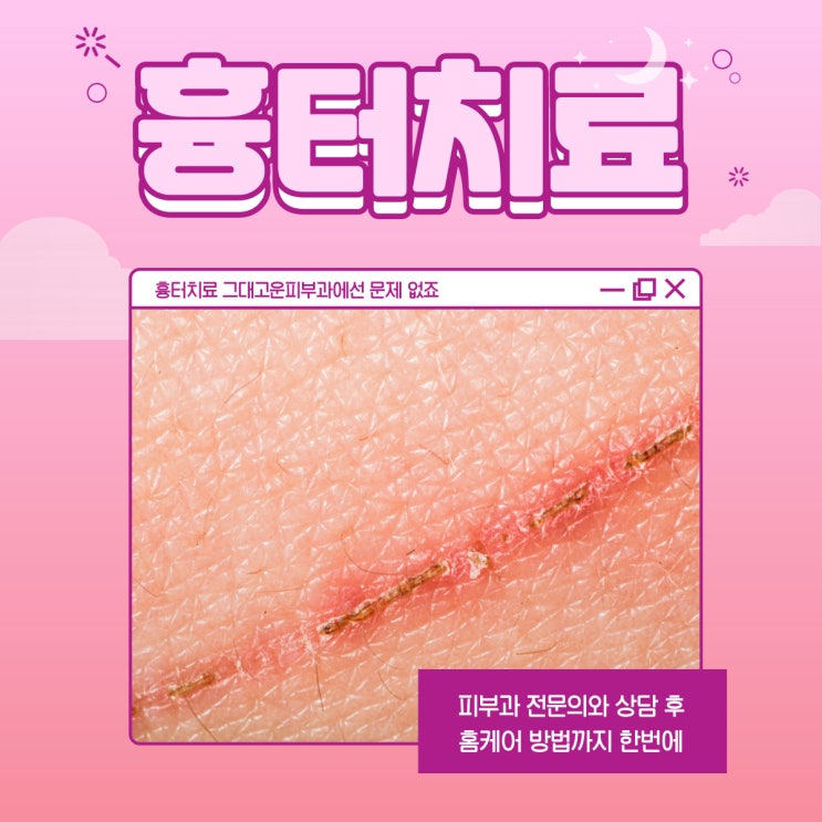 부산 센텀 수술 흉터 치료, 레이저만으로 치료 가능할까? 부산 센텀 수술 흉터 치료, 레이저만으로 치료 가능할까?
