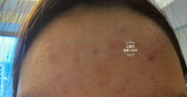  화장품 맞지않아, 피부염(모낭염)올라왔어요. 치료방법 공유해요 [고을의 명품스토리]
