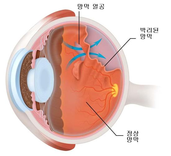  망막박리란?