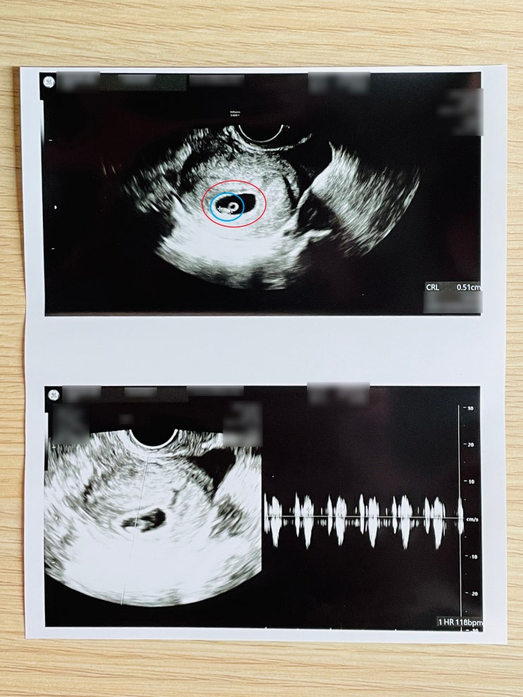 [6주 차] 아기집 안에 아기가 보이기 시작한다! 심장 소리도 들림~