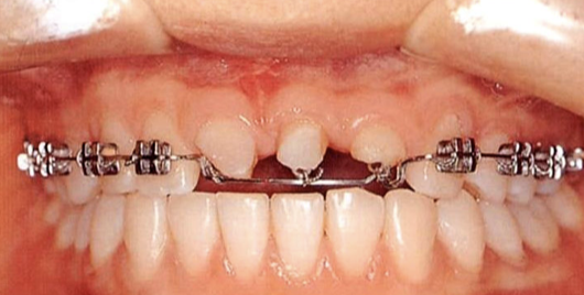 뿌리만 남은 치아 살리기 - 외상 받은 치아의 교정적 치아정출술
