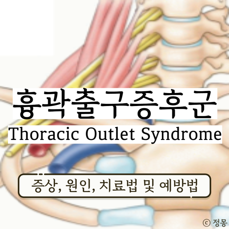 흉곽출구증후군 증상 원인 치료 및 예방법 (팔과 손이 저리고 아프다면) 흉곽출구증후군 증상 원인 치료 및 예방법 (팔과 손이 저리고 아프다면)