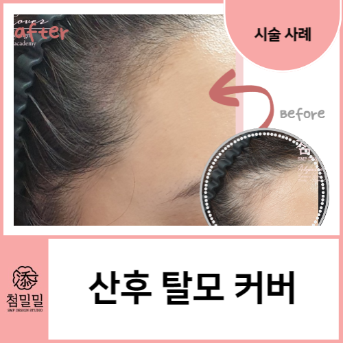  포항 산후탈모, 출산후 머리빠짐으로 스트레스 받을 때, 첨밀밀 두피SMP(feat.리얼 사례)