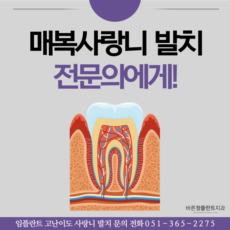  동래치과 매복사랑니 발치 구강외과전문의에게 맡겨야해요