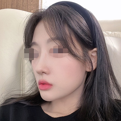  매부리코교정 후,매끄러운 콧대(신사역성형외과 치유)