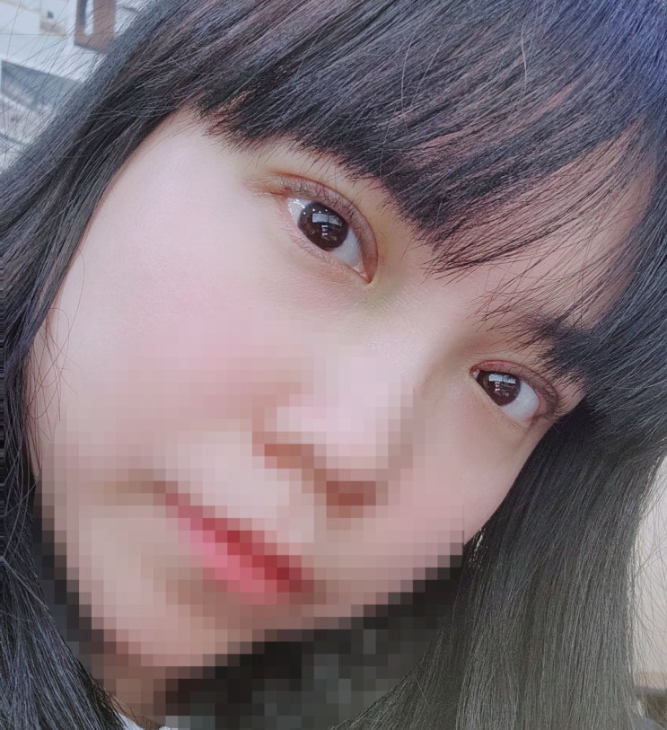  신사역 자연유착쌍꺼풀 수술 솔직하고 생생한 후기!! ( 1주차 )