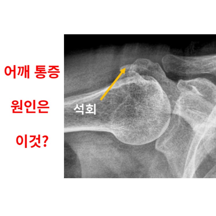 어깨에 석회 치료 했는데 재발한 이유 2가지