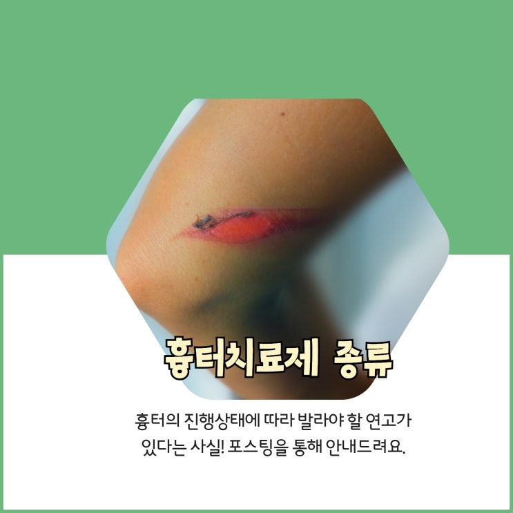  흉터치료제 종류, 흉터치료연고 종류 : 더마틱스 울트라, 콘투락투벡스, 벤트락스겔, 스카덤겔, 시카케어, 켈로코트겔 등
