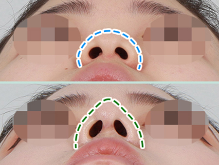  복코교정/뭉툭한 코끝-반듯하고 얄쌍하게<강남복코교정,직반버선코>