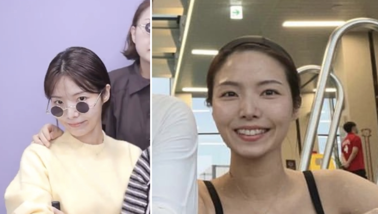  3년이상 받아온 사각턱 보톡스효과 전후비교 후기 / 명동보톡스 통증, 주기, 제오민