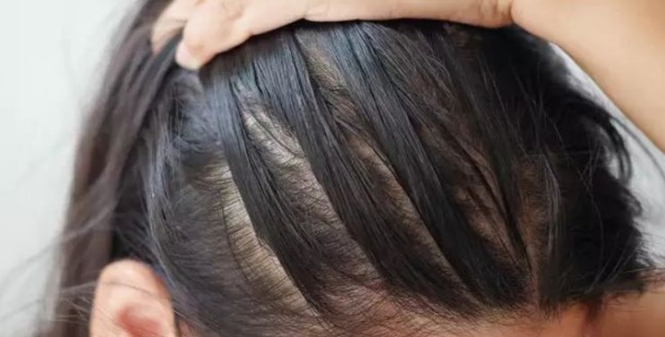  헤어라인문신 샴푸 언제 가능할까? 관리법까지 알려드려요