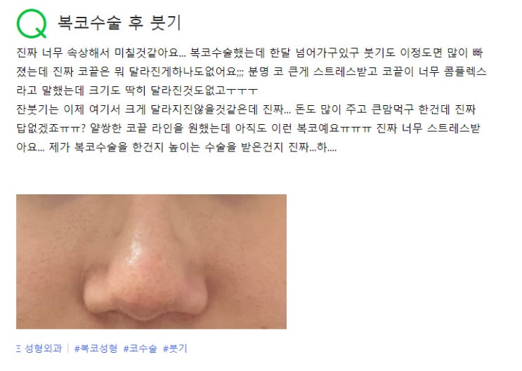  복코수술 후 붓기.. 너무 속상해서 미칠것같아요...(성형외과)
