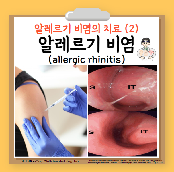  환절기 알레르기 (5) - 알레르기 비염 (allergic rhinitis)의 치료 - 면역요법 수술요법