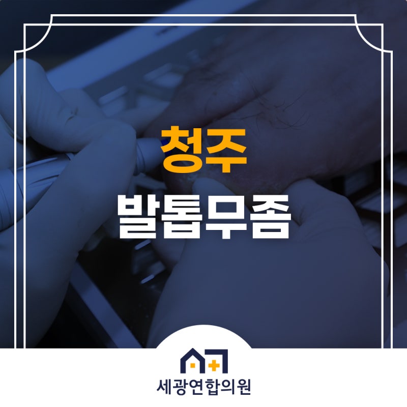 청주발톱무좀 초기진료로 레이저치료