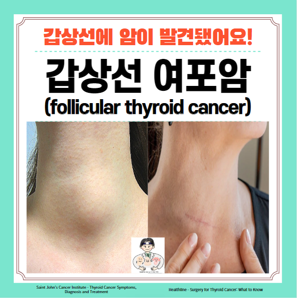  갑상선암 (2) - 갑상선 여포암 원인 증상 진단 치료 수술 예후