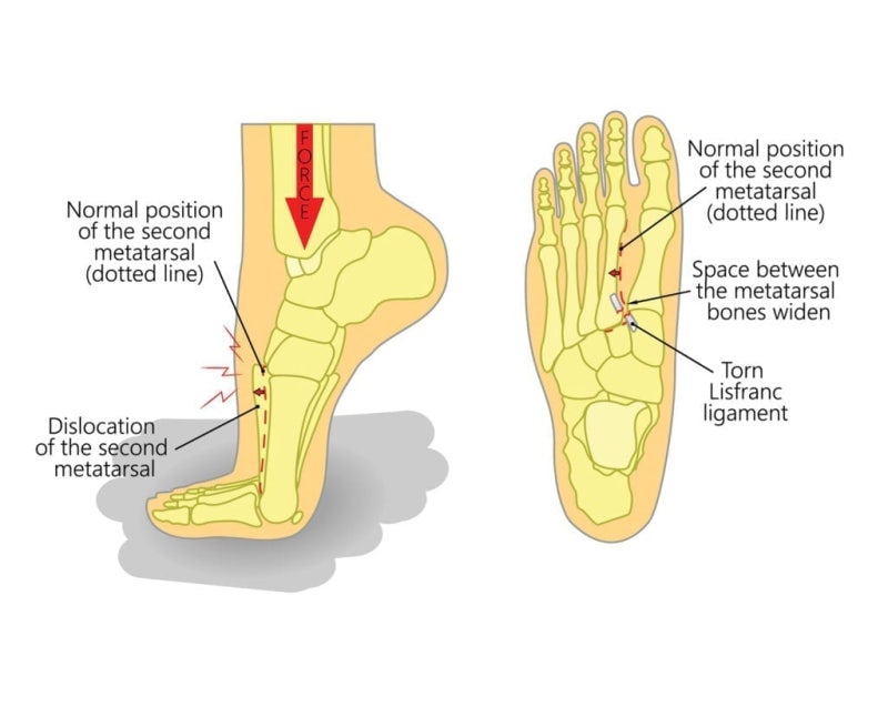 Lisfranc Injury lisfranc-injury
