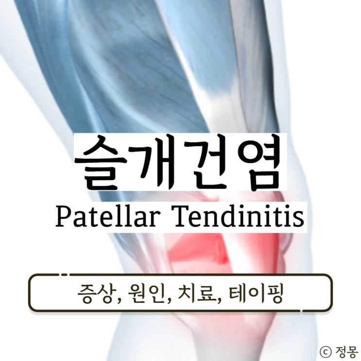 슬개건염 증상 원인 치료 테이핑 슬개건염 증상 원인 치료 테이핑