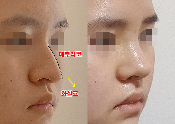  화살코교정, 마녀코 탈출~~(강남성형외과 유명한곳 치유)