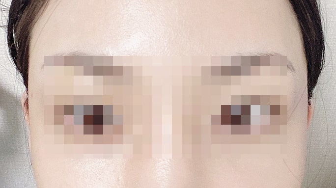  [비쥬필후기] 관자놀이 필러 관자필러 후기