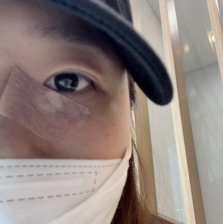  [나음피부과] 흉터 레이저치료 2회차 기록