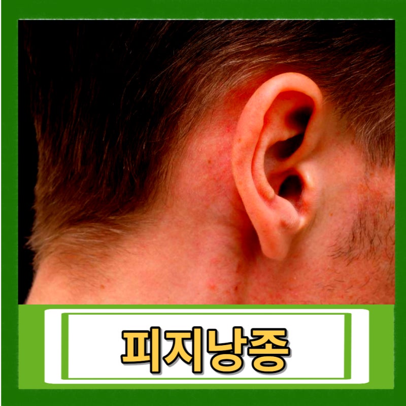 귓볼 몽우리 귀뒤 피지낭종 표피낭종 여드름 염증 부음 고름 통증 병원 치료 체크해요 : 네이버 블로그