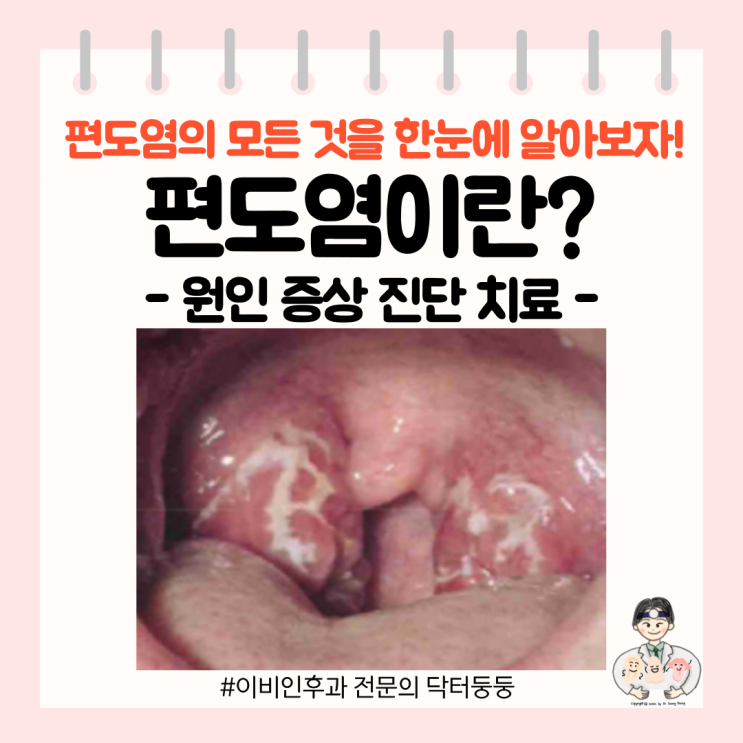  [1분 뉴스] - 편도염 편도선염 원인 증상 진단 치료