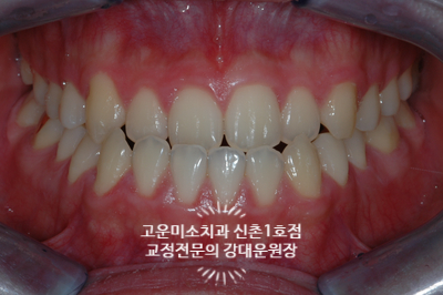  3급부정교합 주걱턱 비대칭 비수술교정치료 신촌교정전문의 고운미소 신촌1호점 치료증례