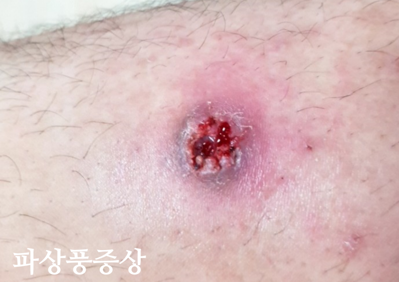파상풍 초기 증상 및 파상풍주사 기간/ 치료/예방접종 : 네이버 블로그